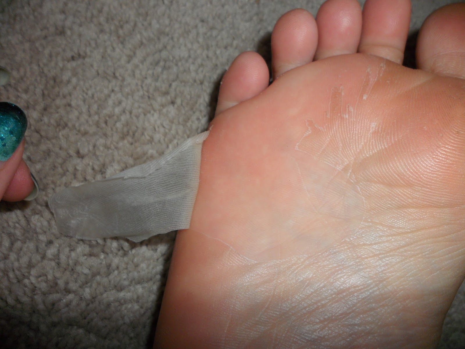 skin peeling on bottom of feet