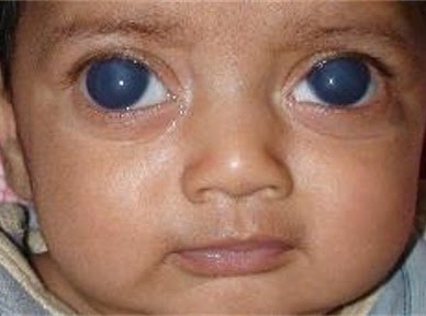 Con OjOs de Niñ SOBRE EL CONGÉNITO