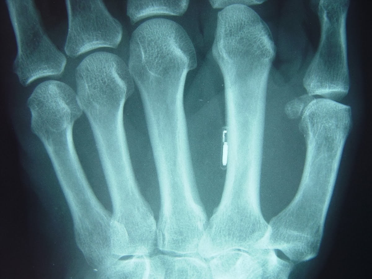 RFID Implants The Benefits vs. the Dangers RFID News