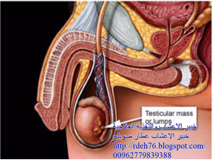 سرطان الخصية السرطان الاورام خبير الاعشاب والتغذية العلاجية عطار صويلح