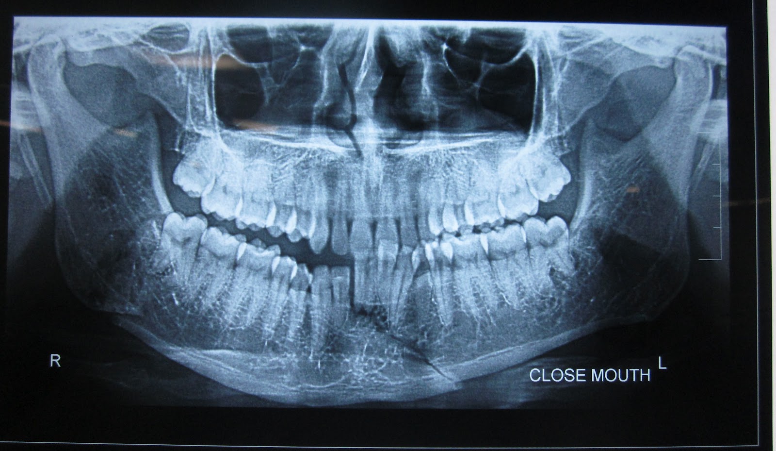 FRACTURE MANDIBLE - ANGLE AND PARASYMPHYSEAL - ORIF ...