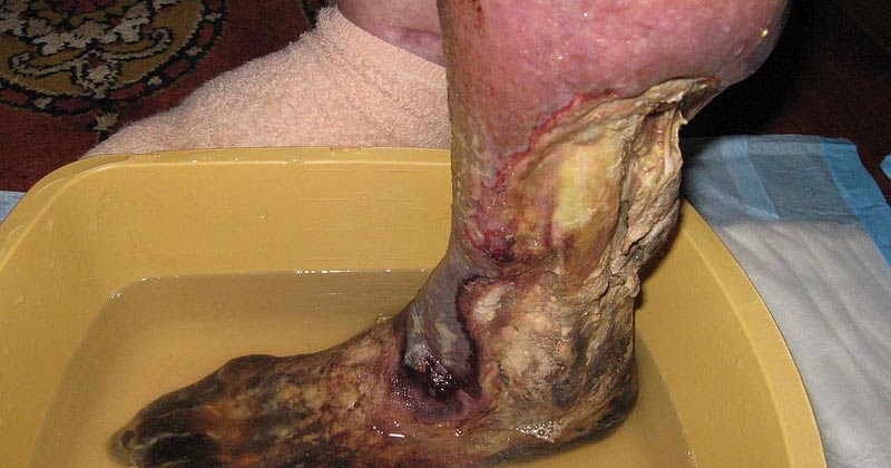 Sistema Inmunologico: Gas Gangrene