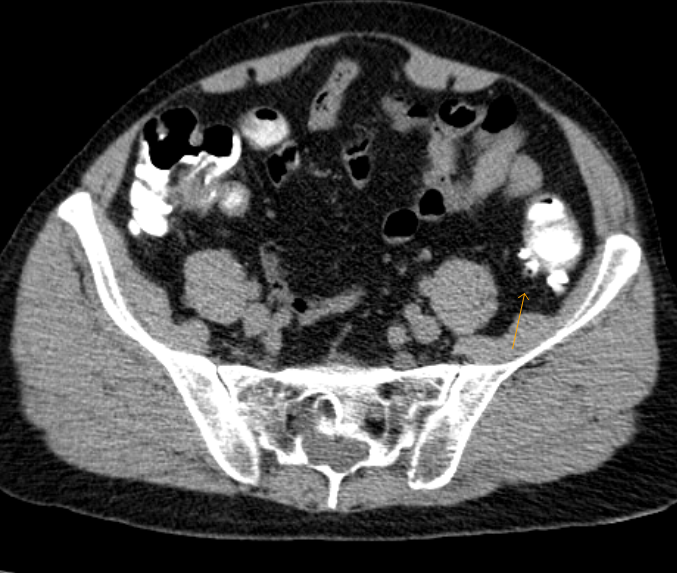diverticulitis ct with contrast