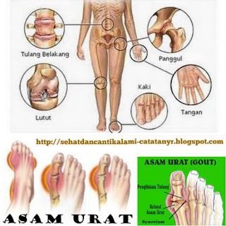 Resep Obat Penyakit Asam Urat dengan Bahan Alami Resep Obat Penyakit Asam Urat dengan Bahan Alami