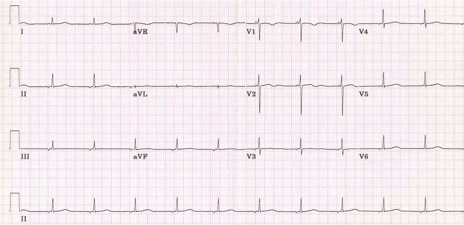 Accelerated Junctional Rhythm