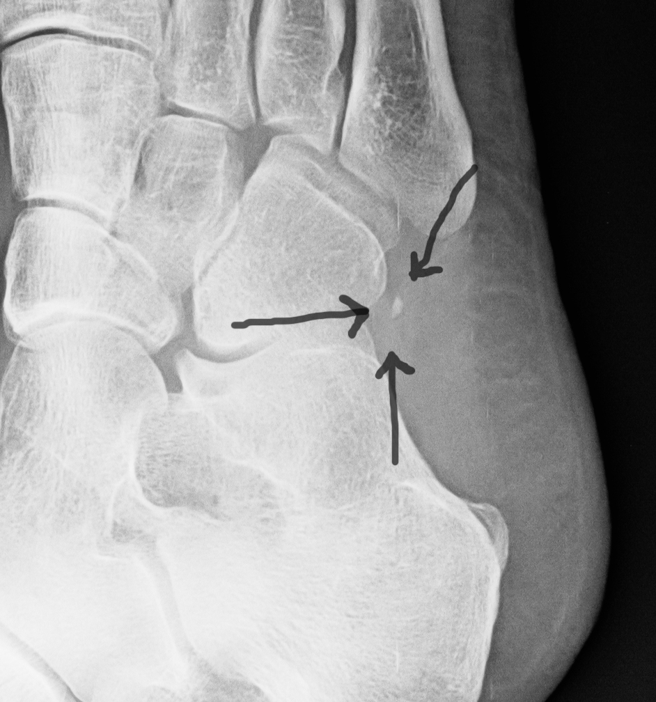 Stress Fracture Of The Foot Monday, August 13, 2012-2.bp.blogspot.com