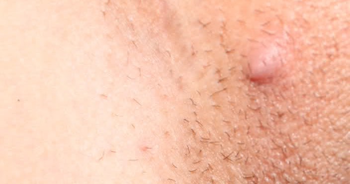 Best of Images of anal blisters XXX photo Tall thin women enormous tits