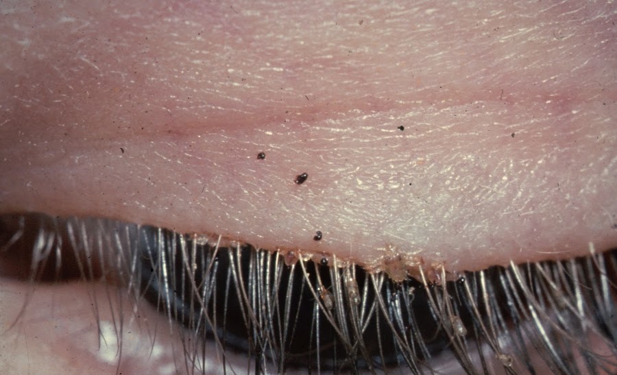 Teledermatology for PG entrance Common Hair shaft infections