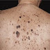 Τι είναι η σμηγματορροϊκή υπερκεράτωση, που μπορεί να έχετε στο δέρμα σας; Πόσο επικίνδυνη είναι και πώς αφαιρείται;