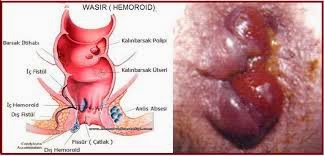 Ambein Untuk Wanita Hamil Ambein Untuk Wanita Hamil