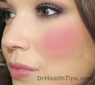 redness of face