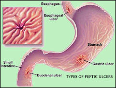 NOOC YADA UU U KALA BAXO CUDURKA PEPTIC ULCER DISEASE.