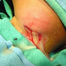 bouton blanc sur les testicules