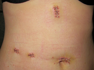 buy dermatix online, buy dermatix silicone scar reduction gel australia, scar reduction treatments, scar treatments