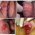 Obat Sipilis Paling Manjur Yang Terbukti thumbnail