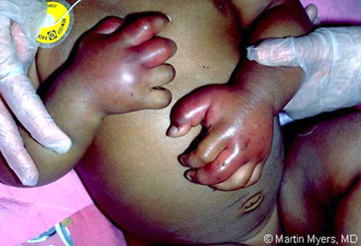 Signs Of Food Poisoning In Babies Signs Of Food Poisoning In Babies