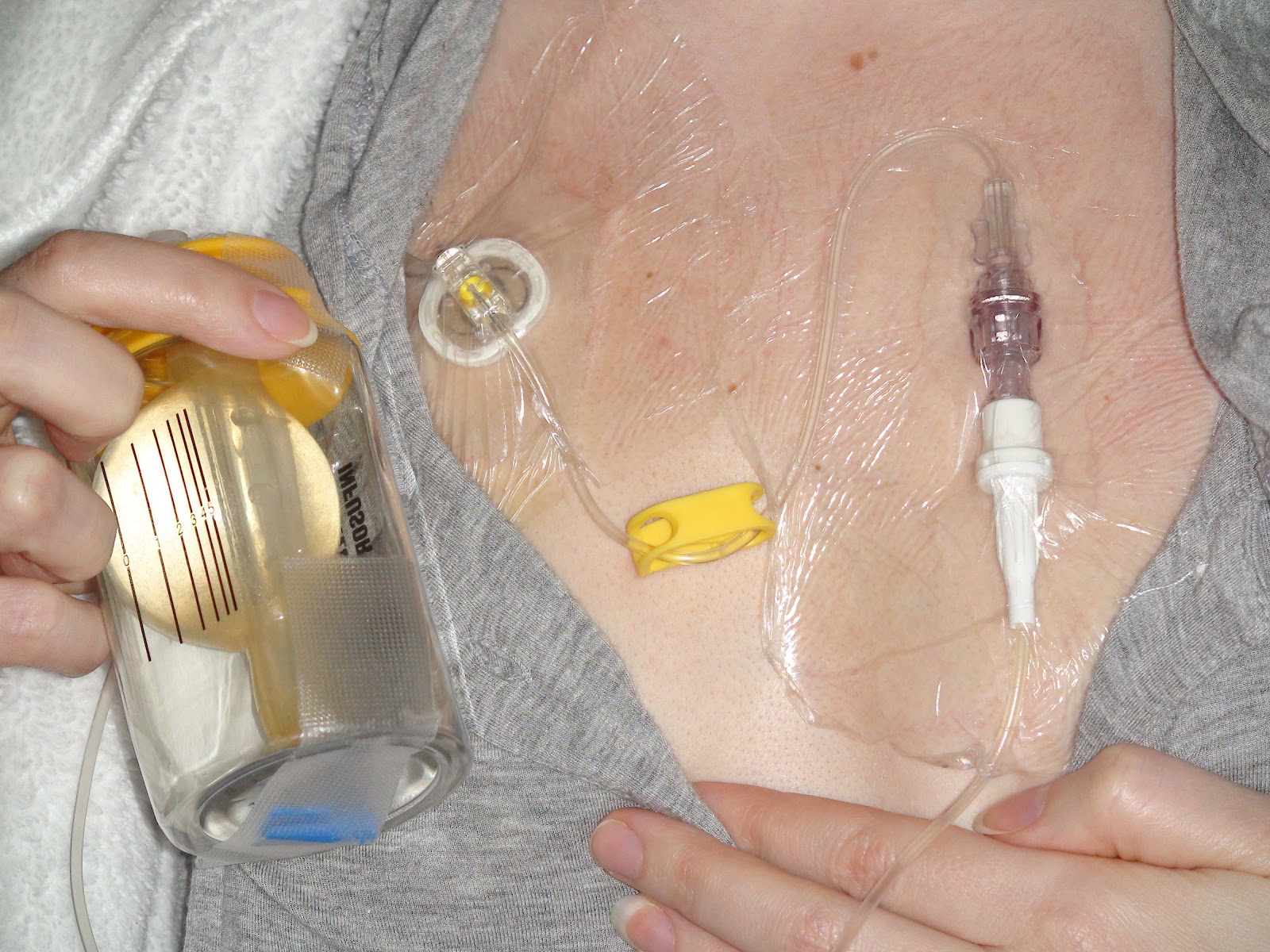 Port A Cath Attached Iv Infusion Beautiful Most Beautiful Port A Cath Attached Iv Infusion Beautiful Most Beautiful