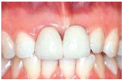 dental bridges prosthodontics dental india dental cantilever bridge dental