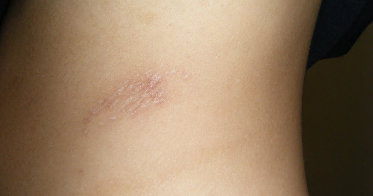 21 and Shingles Shingles scars