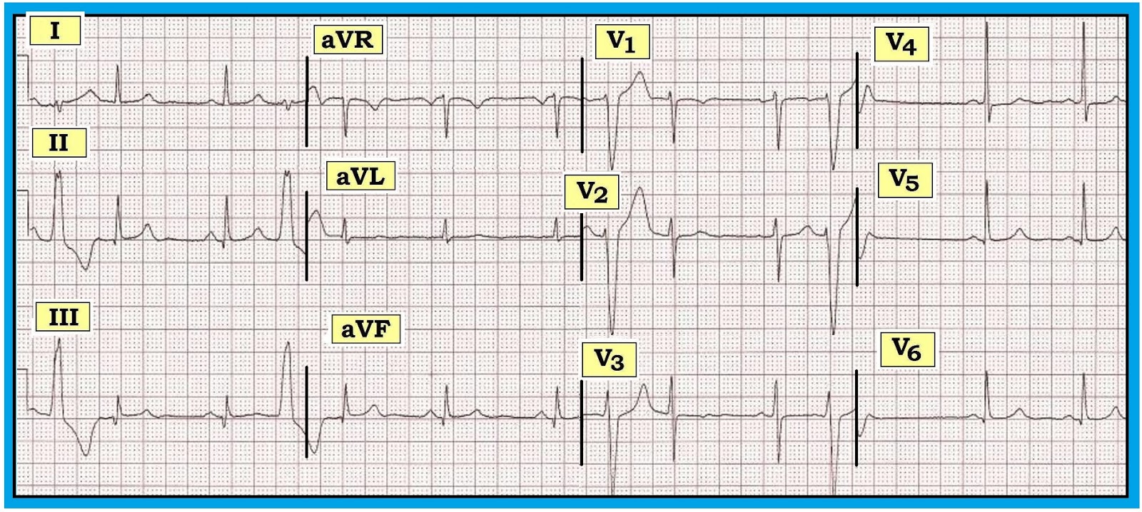 ecg recognition Posterior mi recognition oct 1st, 2015 manuel celedon the standard ecg lead placement cannot directly illustrate what is occurring in the posterior heart. ecg recognition Posterior mi recognition oct 1st, 2015 manuel celedon the standard ecg lead placement cannot directly illustrate what is occurring in the posterior heart.