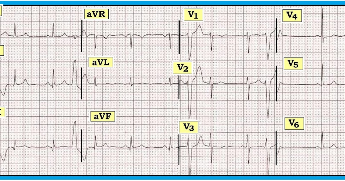 ECG Interpretation ECG Interpretation Review 68 (PVC Interpolated