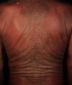 Psoriasis eritrodermica Psoriasis eritrodermica