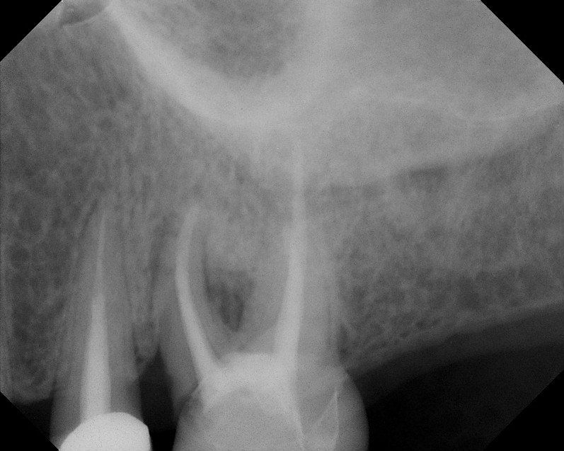 The Endo Blog Using CBCT to Identify Vertical Root Fractures Use of