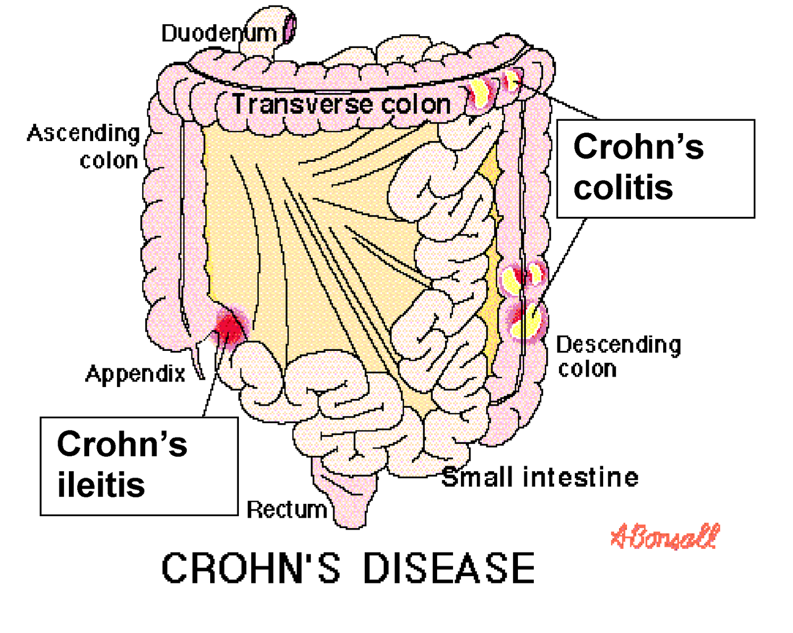 Inspiring Reader Chron's Disease