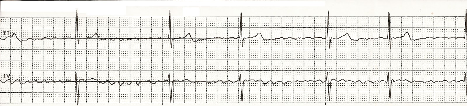 cvml_0080a_Atrial_Fibrillation_1920x1080 (00000)