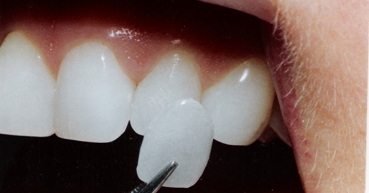 Dental Travel Poland Dentists in Poland Blog Dental camouflage