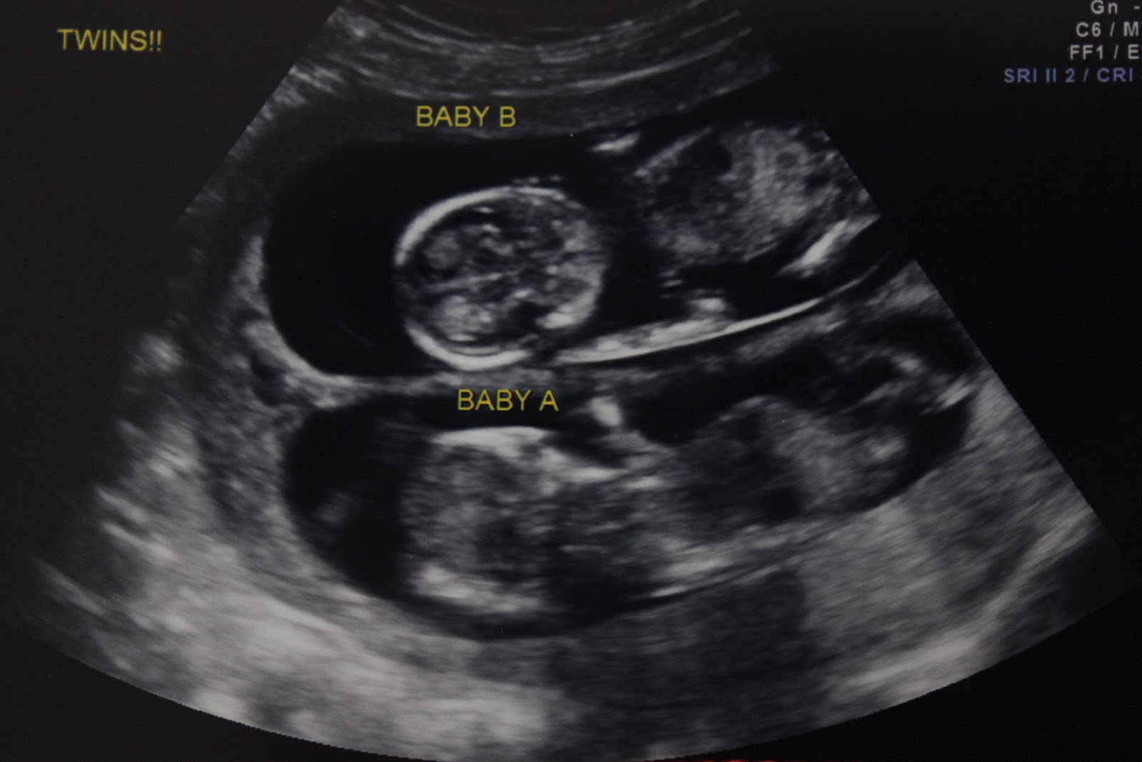 The Creighton Family Gage's first day, twins 2nd ultrasound