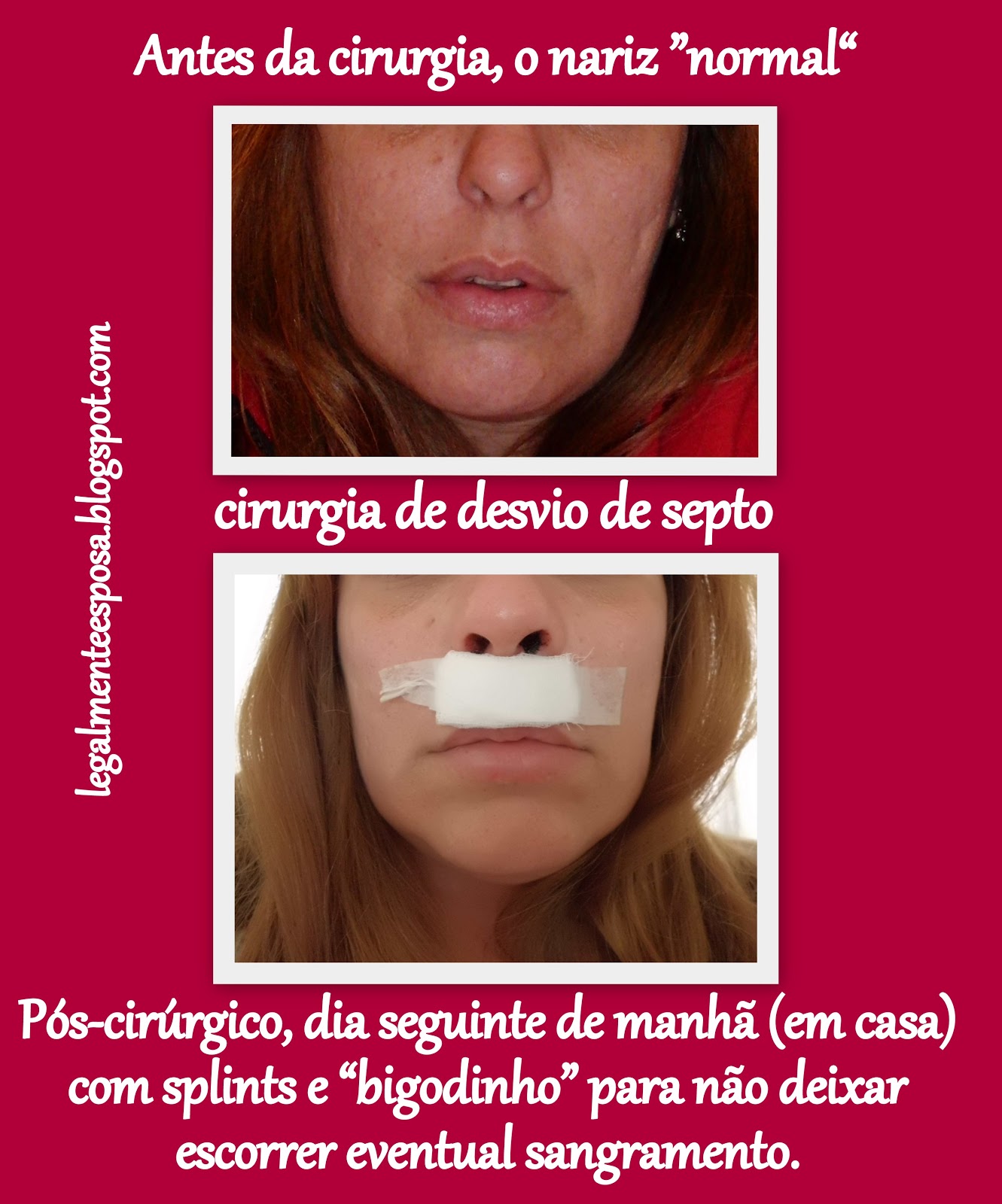 Legalmente Esposa: Cirurgia de Desvio de Septo e Sinusite (chegada no