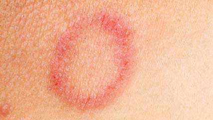 Left Ring Finger Rash Left Ring Finger Rash