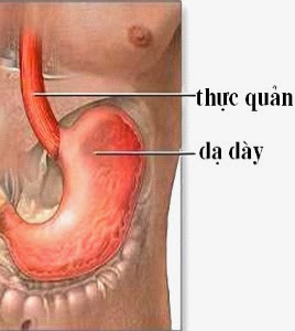 Viêm hang vị dạ dày - hỏi và đáp