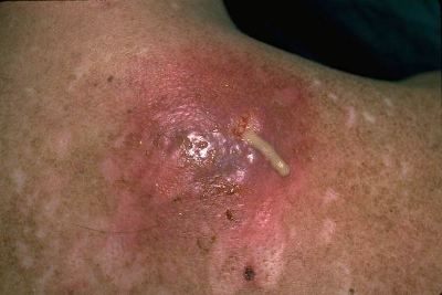 9 Home Remedies For Boils photo 9 Home Remedies For Boils foto