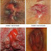 Gejala Ambein Berdarah thumbnail
