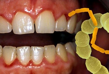gum mouth disease diabetes tooth dry health bacteria dental problems healthy teeth gums gingivitis diseases oral inflammation related cure problem