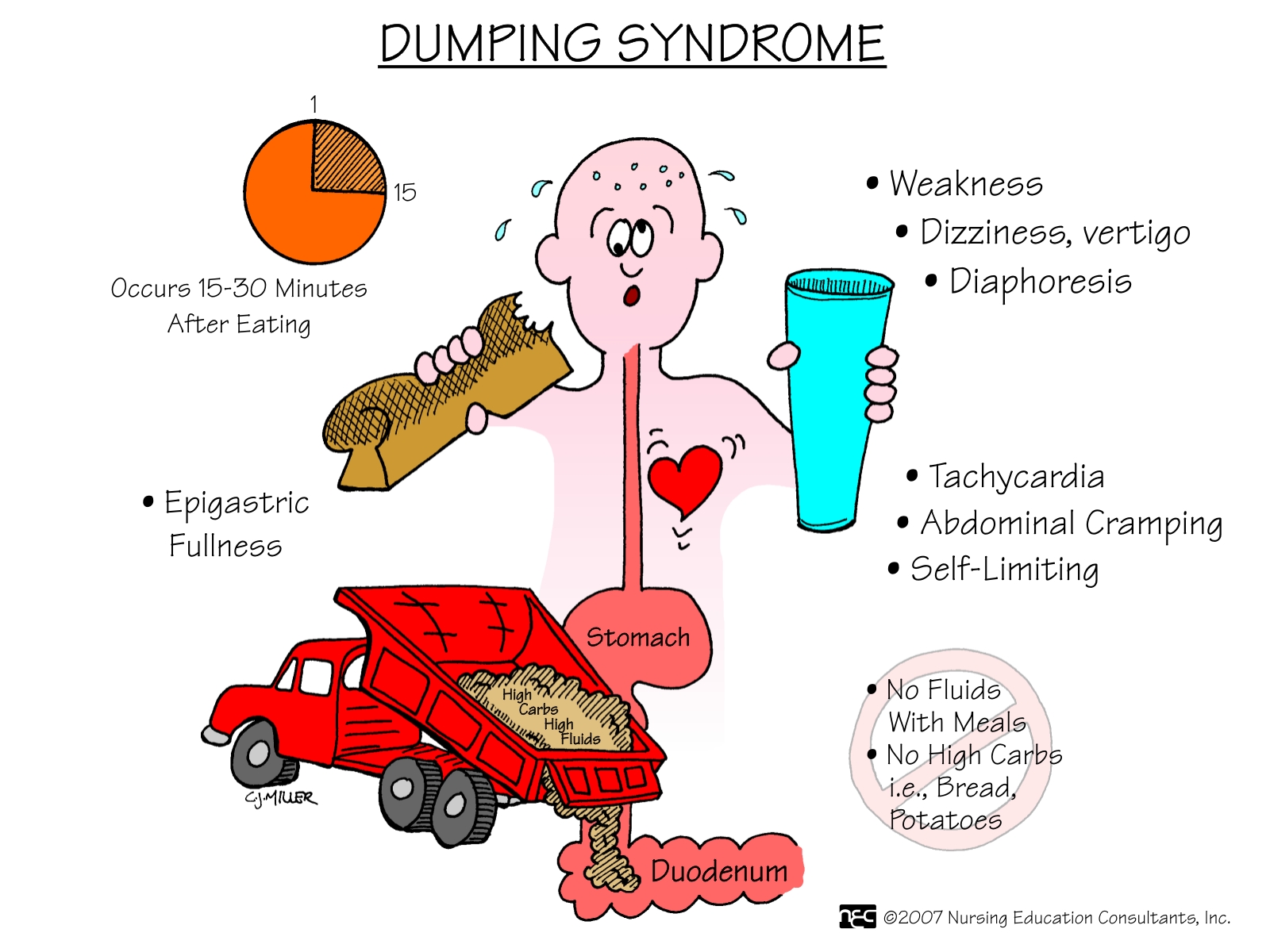 Dumping+Syndrome Dumping+Syndrome