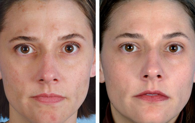 Before After Microdermabrasion