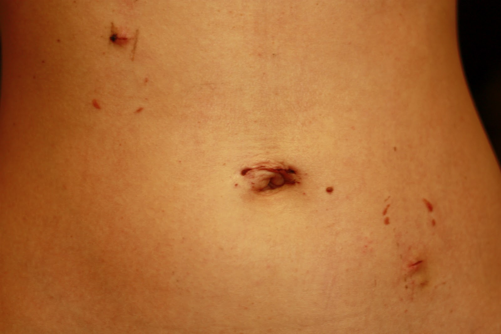 The Gallery For Appendix Removal Scar.