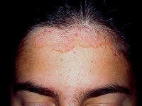 Dermatitis seborreica