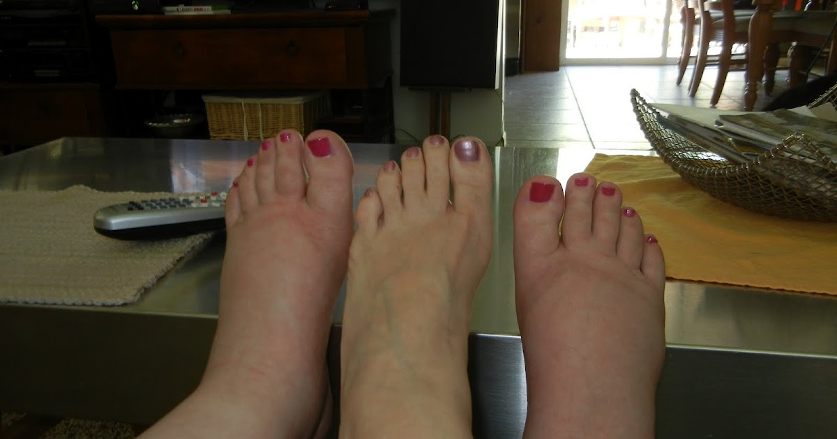 Forever and for Always Swollen feet leads to bed rest which then leads