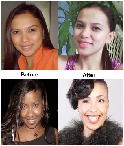 Skin Whitening Forever Skin Whitening Forever
