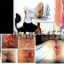 Mengobati Wasir Selain Dulcolax Supositoria (dimasukan ke anus) thumbnail