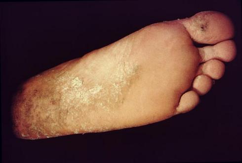 La uña negra sobre el pulgar el tratamiento