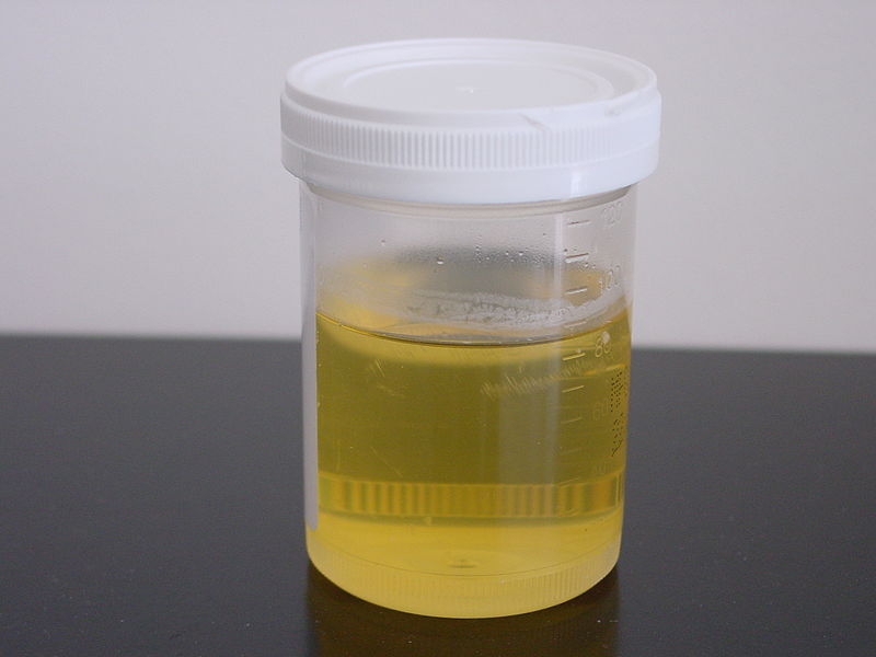 What are some causes of cloudy urine?