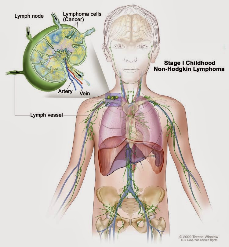 Hodgkin Lymphoma Cancer Dream Health