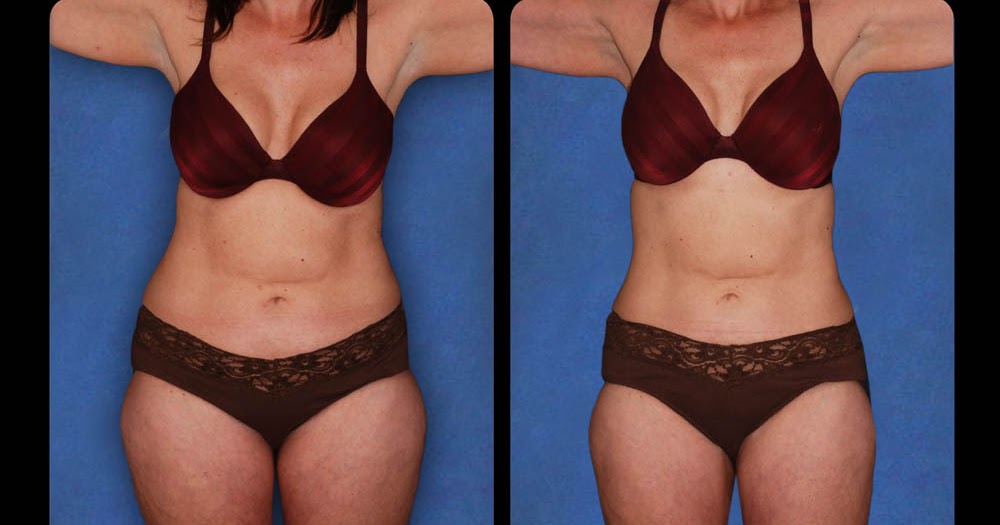 B12 Shots for Weight Loss