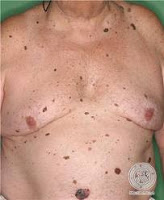 melonoma, causas del melanoma,     tipos de melanoma, sintomas de melanoma, tratamiento de melanoma,