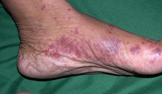 Does Kawasaki Disease Go Away Does Kawasaki Disease Go Away